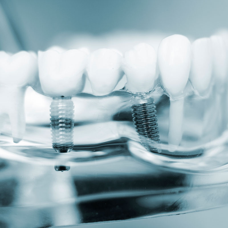 3D電腦斷層植牙