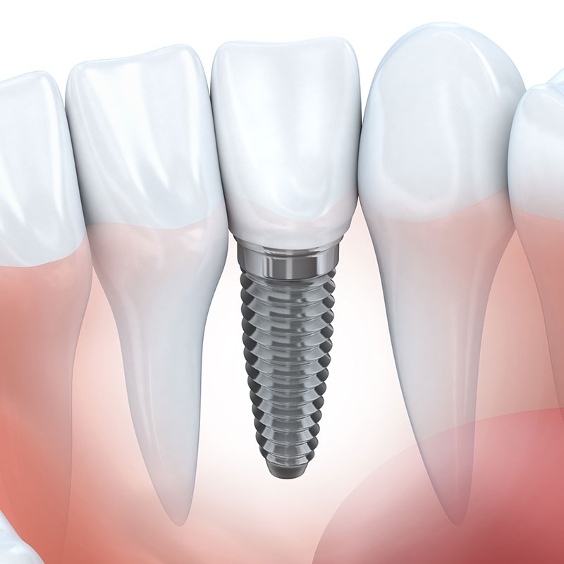 糖尿病高血壓植牙