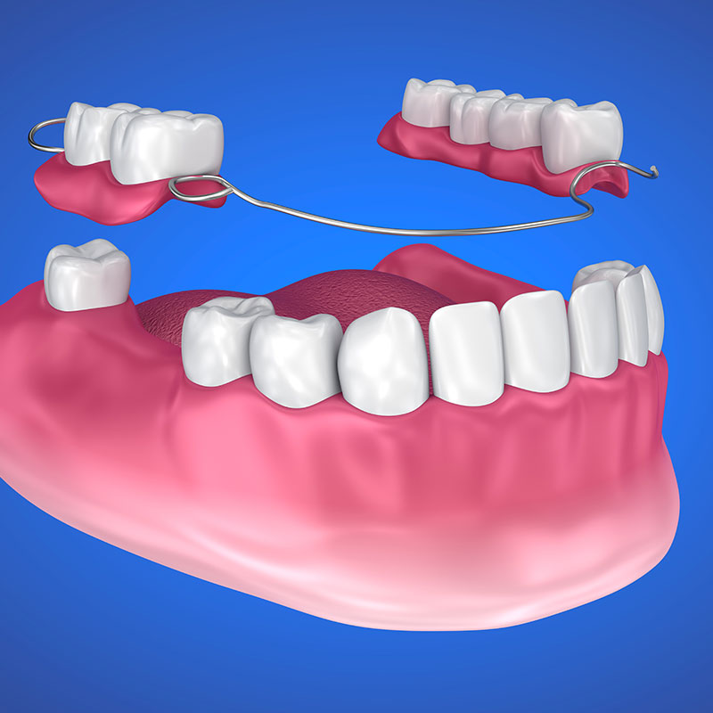 糖尿病‧高血壓植牙