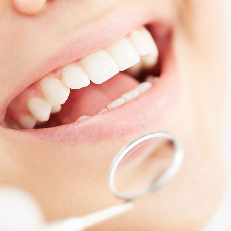 3D齒雕(除汞治療)